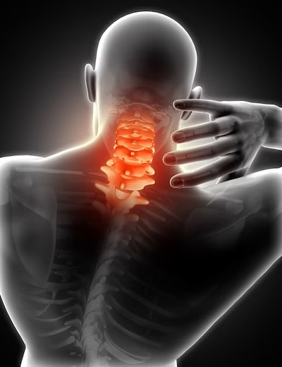 Neck Pain 